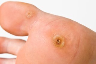 Photograph of two verruca's on light skin on the ball of a foot. One larger yellow spot around 1cm in size with a black dot in the centre, the other 20mm in size.