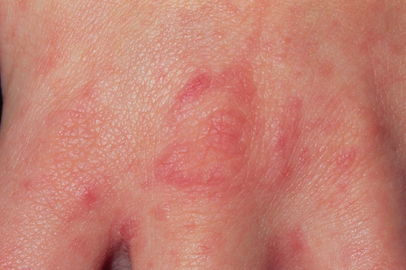 Red blotchy rash on light skinned knuckle and in between fingers.