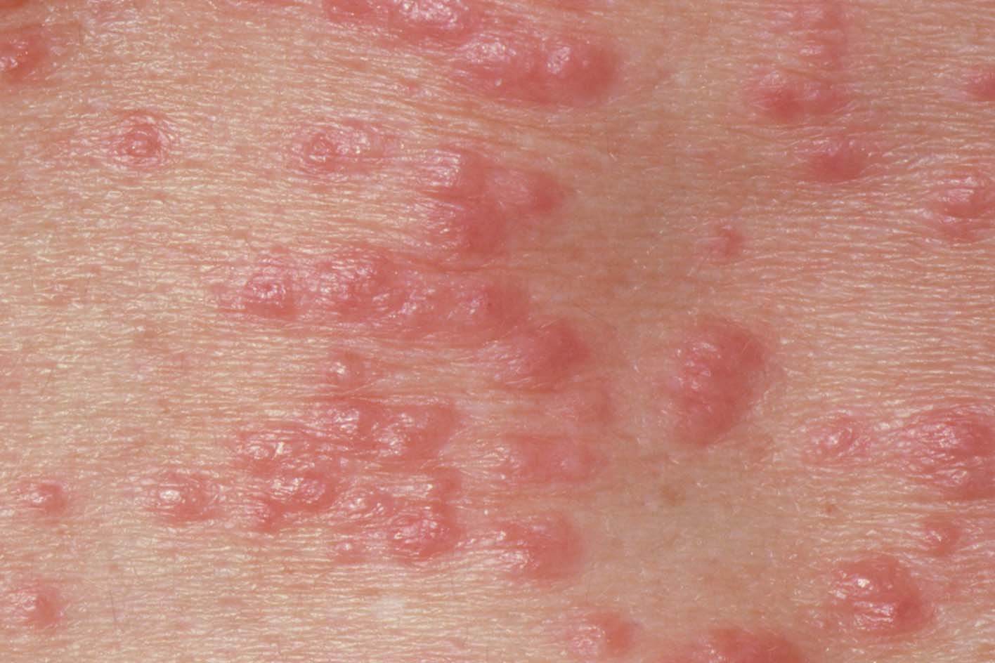 Close up of light skin with lots of red and pink raised shiny smooth dots